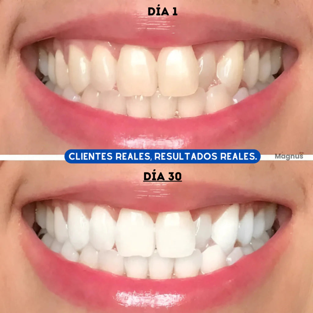 DAZZWHITE™ Lápiz blanqueador dental